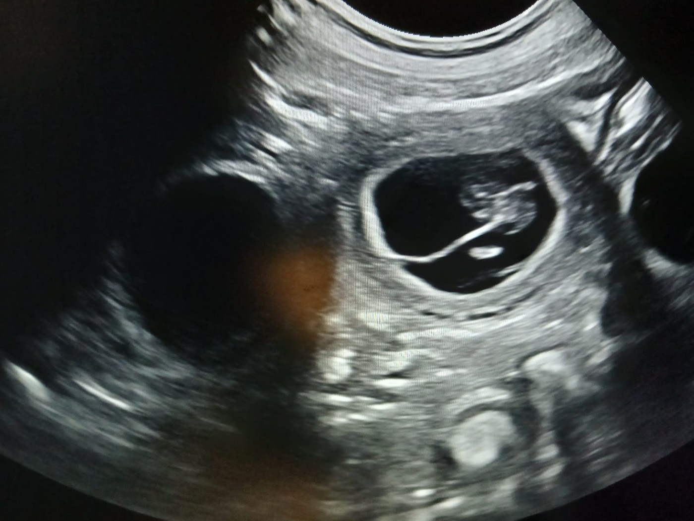 Gestation confirmée